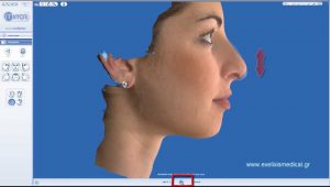 rhinoplasty 3d simulation plastic nose 11