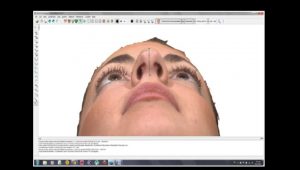 rhinoplasty 3d simulation plastic nose 13