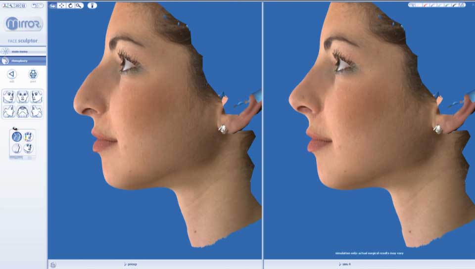 3D Rhinoplasty Nose job Surgery simulation