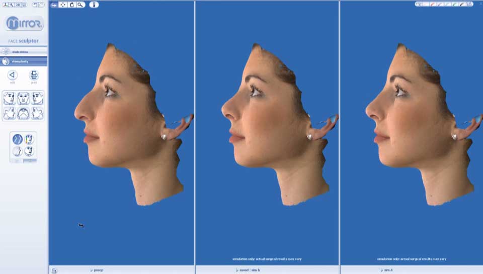 3D Rhinoplasty Nose job Surgery simulation