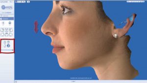 rhinoplasty 3d simulation plastic nose 9